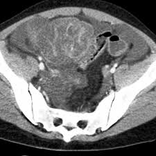 Image result for Neutropenic Colitis