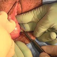 Excision Of A Bartholin Gland Cyst | Mdedge Obgyn