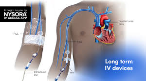 Image result for Peripheral IV Access
