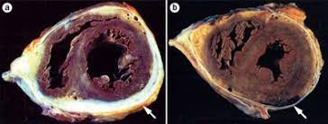 Cardiac surgery is now one of the most frequent causes in developed countries, while tuberculosis remains the most prevalent cause in developing countries. Pericardite Constritiva O Que E Sintomas Diagnosticos E Tratamento Medway