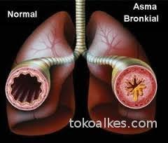 Untuk beberapa hari ke depan. Tanda Asma Tokoalkes Com Tokoalkes Com