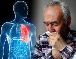 Cigarette smoking—smoking causes about 85 out of 100 cases of lung cancer. Lung Cancer Warning What Colour Are Your Eyes Hidden Signs Of A Tumour In Your Eyes Meltingood Com