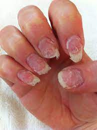 As long as you're gentle and careful, your. This Can Occur When Moisture Collects Under Acrylic Nails It Is More Common With Nails That Are Left On For 3 Mont Nails After Acrylics Nail Repair Thin Nails