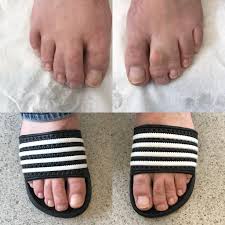 Check out our webbed toes selection for the very best in unique or custom, handmade pieces from our shops. Syndactyly Webbed Fingers Or Toes Medicare Cosmetics