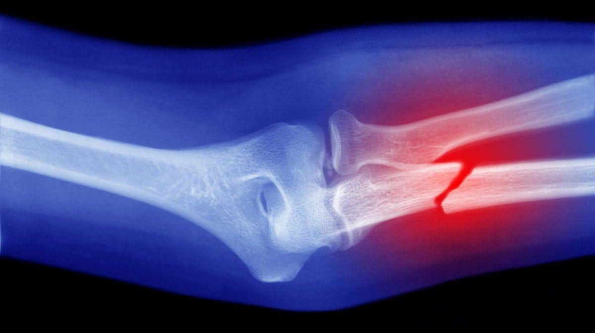 Fracture Repair product image