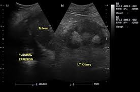 Patients with pneumonia have a poorer the bts guidelines state that aspiration should not be performed for bilateral effusions in a clinical. Bilateral Pleural Effusions With Ascites Radiology Case Radiopaedia Org