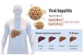 Jul 01, 2021 · hepatitis, inflammation of the liver that results from a variety of causes, both infectious and noninfectious. Medizin Nobelpreis Fur Entdecker Des Hepatitis C Virus Drei Forscher Ermoglichten Die Erkennung Und Heilung Der Todlichen Lebererkrankung Scinexx De