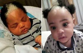 Baby's White Hair Streak Is Actually a Rare Inherited Genetic Condition