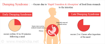 Dumping Syndrome Causes Symptoms Diagnosis Treatment