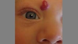 Tiny, pinpoint hemorrhages can be seen in the skin and are referred to as petechiae. Infantile Hemangiomas About Strawberry Baby Birthmarks Healthychildren Org