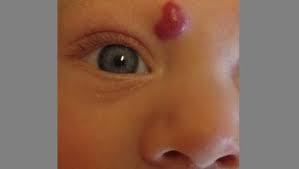 They are a harmless benign tumour, containing an abnormal proliferation of blood vessels, and have no relationship to cancer. Infantile Hemangiomas About Strawberry Baby Birthmarks Healthychildren Org