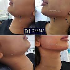 derma contour package jawline sculpting with cheekbones can contour and sharpen the facial feature facial fillers facial contouring body contouring surgery