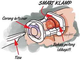 Tips penjagaan selepas bersunat | cuti sekolah hujung tahun dan bersunat berpisah tiada. Anak Bersunat Cara Clamp