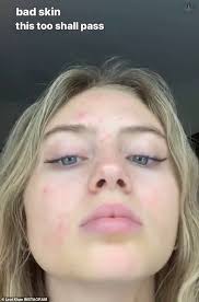 Nachdem sie heidi klum auf der liege platt gedrückt hatte, bekommen hans und franz etwas licht. Heidi Klum S Daughter Leni 16 Gets Real About Her Acne As She Reveals Her Bad Skin On Instagram Duk News
