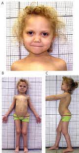 The patient aged 6 years. A: A dysmorphic face with hypertelorism and a...  | Download Scientific Diagram