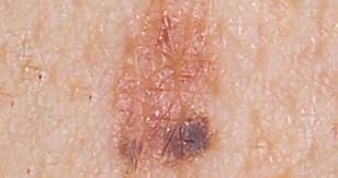 El cancer de piel aparece en los llamadas lunares( termino medico nevos) si los lunares cuando el cáncer crece, éste puede empujar los nervios más cercanos, órganos y arterias, los cuales pueden causar síntomas y señales de que se tiene la enfermedad. Fotos Asi Se Manifiesta El Cancer De Piel Meganoticias