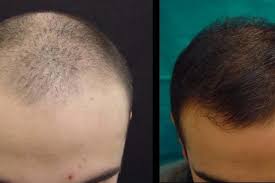 E' possibile pagare a rate il costo del trapianto capelli, trapianto capelli: Trapianto Autologo Dei Capelli Skinlaser