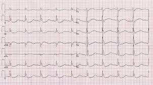 Review the ecg (ekg), present it according to the structure in ecg interpretation and attempt a question 1. Ecg Ekg Examples And Quiz Oxford Medical Education