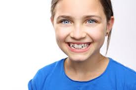 Be cautious of which teeth are loose first. Do All Your Baby Teeth Need To Fall Out Before You Get Braces Wees Low Orthodontics