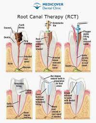 Medicover Dental Clinic Dental Treatments Root Canal Treatment Root Canal Dental Hygiene School