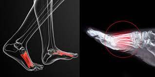 Douleur du pied le figaro santé. Metatarsalgie Syndrome De Morton Symptomes Guerison Durillons Cors