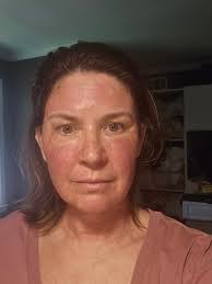 What is the total recovery time for co2 skin resurfacing laser treatment