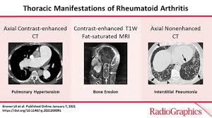 Thoracic Manifestations Of Rheumatoid Arthritis Radiographics