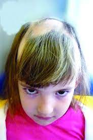 But hair loss also can be a side effect of some medicines used to treat acne, bipolar disorder, and adhd. Hair Loss In Children
