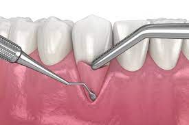 gums