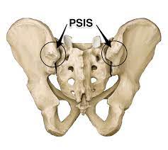 The posterior superior iliac spine serves for the attachment of the oblique portion of the posterior sacroiliac ligaments and the multifidus. Psis Google Search Yoga Anatomy Psoas Release Anatomy