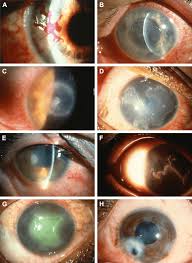 Hsv1 latency sites after inoculation in the lip. Representative Images Of Various Corneal Damages Due To Hsv1 Infection Download Scientific Diagram