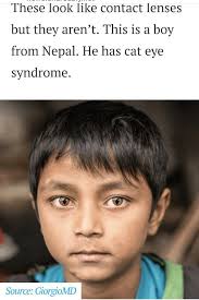 pin by dena saunier on stuff cat eye syndrome syndrome contact lenses
