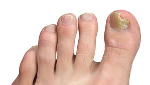 To prevent infecting other people, apply nail varnish to give a verruca a waterproof seal. Get Your Feet Ready For Summer West Berkshire Foot Clinic