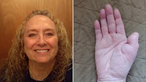 These fat deposits show up mostly on the legs, trunk and arms, explains eileen s. Woman With Skin Cancer Gets New Thumb After Doctors Transplant Toe Unto Hand Metro News