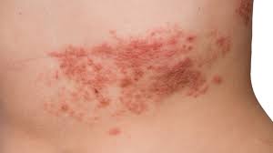 Image result for herpes zoster