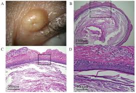 Image result for milium cyst on eyelid