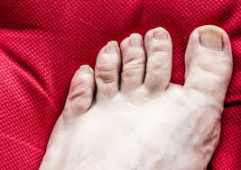 Esta no es una tarea fácil, las uñas de los pies largas son una forma definitiva de atraer la atención a esta hermosa parte del cuerpo. Uncared Pies Con Las Unas Largas Fotos Retratos Imagenes Y Fotografia De Archivo Libres De Derecho Image 55376159