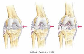 The ligaments in the knee connect the femur (thighbone) to the tibia (shin bone), and include the following: Acl Knee Injury Players Who Overcame It Physioroom Blog