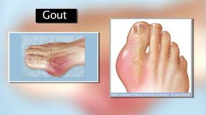 Gout Mayo Clinic Youtube