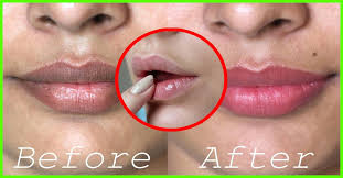 To get rid of a scabbed pimples: 10 Best Home Remedies To Cure Black Spots On The Lips