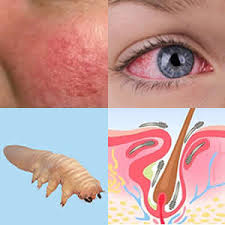 Image result for demodex rosacea