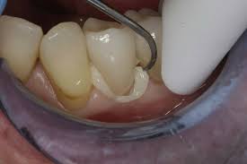We did not find results for: Cementation Choices Simplified Bondistry
