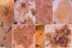 Image result for Solar Lentigo