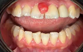 Image result for granuloma gum disease