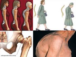 Osteoporoz yani halk arasında bilinen adı ile kemik erimesi, kemiklerin zayıflamasına kırılgan bir hal almasına verilen. Kemik Erimesi Erkekleri De Etkiliyor