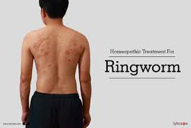 Homeopathic Treatment For Ringworm Fungal Infection By Dr Kuravi V S M K Pavan Kumar Lybrate Learn how this contagious skin condition affects different parts of the body. homeopathic treatment for ringworm