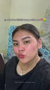 Effective Acne Treatment with Niacinamide Serum