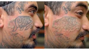 However, the advent of laser tattoo removal technology has resulted in it being almost. Tattoo Removal How To Costs Before And After Pictures More