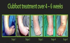 In a club foot, the entire foot is twisted down and in, to the point that it looks like the feet are upside down, with the soles pointed upward. Club Foot Treatment Rotary Showcase
