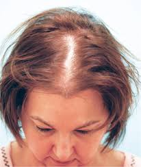 New research found that people in china in their 20s are going bald sooner than any generation before them. Female Pattern Baldness Tir Na Nog Clinic Hair Restoration Medical And Surgical Aesthetics
